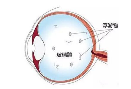 玻璃體混濁