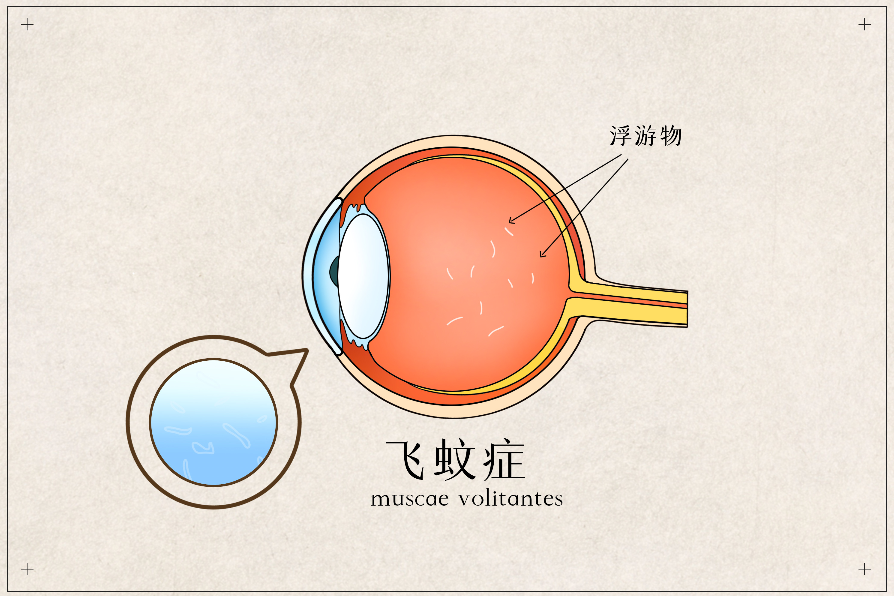 眼睛有飛蚊癥用什么藥